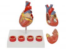 动脉粥硬化带血栓模型