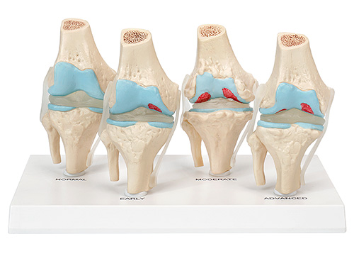膝关节健康病态比较模型,4阶段膝关节病变模型