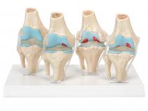 4阶段膝关节健康病态比较模型