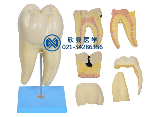 磨牙蛀牙解剖放大模型,右侧第一下磨牙蛀牙模型