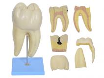 磨牙蛀牙解剖放大模型-右侧第一下磨牙蛀牙模型