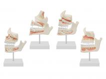 牙齿发育顺序模型-牙与颌骨的发育模型