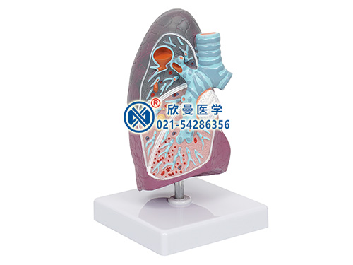 病理肺模型,肺部病变模型,吸烟肺模型