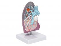 病理肺模型-肺部病变模型