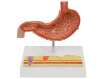 病理胃模型-胃炎模型